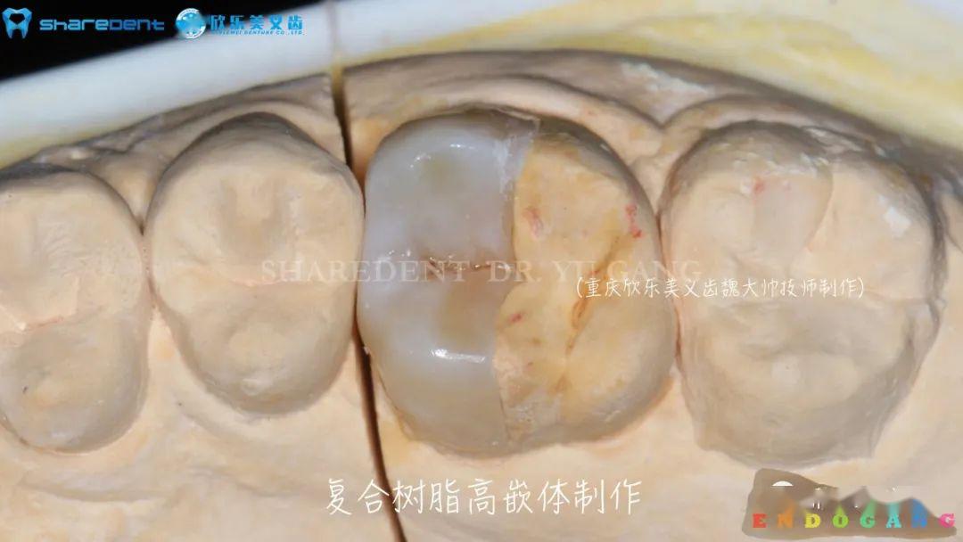 二诊:16热牙胶充填 16嵌体预备 15远中邻面龋齿充填 三诊:16戴复合