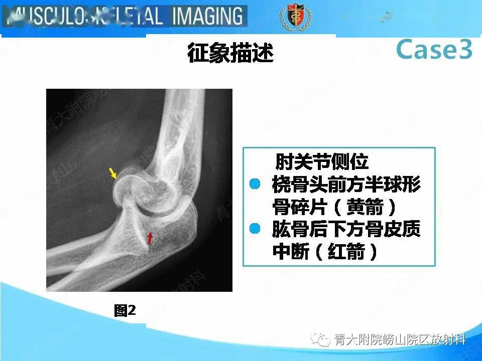 【每日一例1046】实例解答:肱骨小头骨折