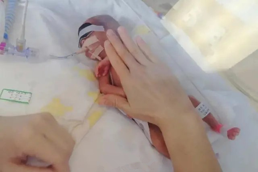 原创胎龄仅25周零6天这位妈妈产下极早早产双胞胎网友看着心疼