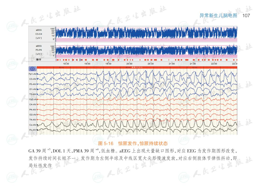 第二章 新生儿脑电图术语解读  第四章 新生儿不同发育阶段正常脑电图