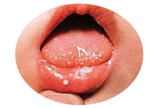 口腔溃疡的症状就是口腔,喉咙,软硬鄂,上下唇内侧等处有小红疹,大多不