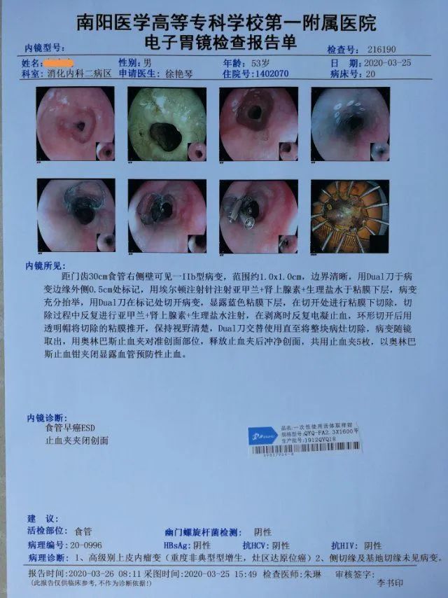 胃镜报告单病理结果回示:高级别上皮内瘤变,灶区原位癌.