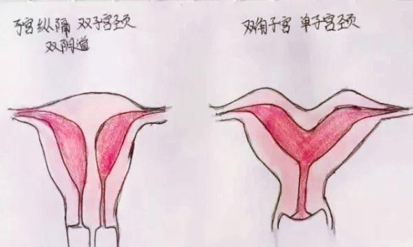 过目难忘!医生手绘畸形子宫图,非常全面,值得收藏!