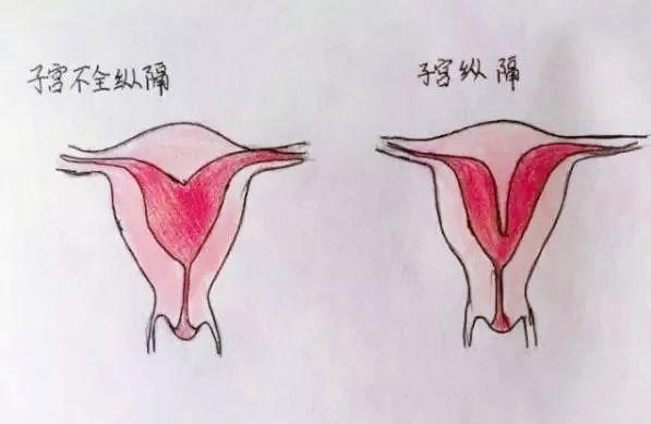 双角子宫(bicornuate uterus) class Ⅴ 纵隔子宫(seperate uterus)