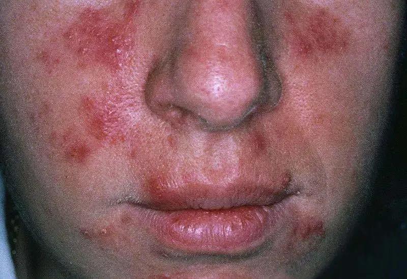 引起痤疮丙酸杆菌,马色拉菌,螨虫的滋生,出现面部皮肤感染,黑头,闭口