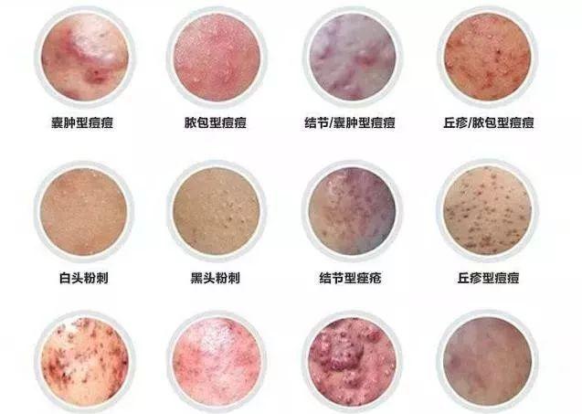 九,聚合型痘痘 聚合型痘痘是指同时患有两种以上痘痘症状,皮肤有一定