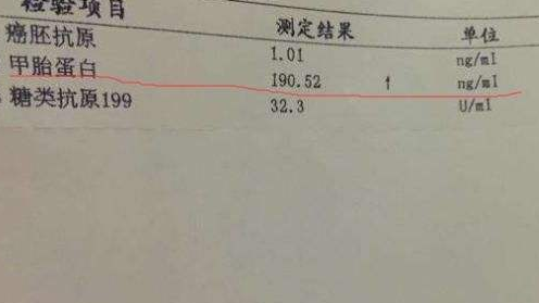 甲胎蛋白升高是肝硬化?专家:不一定,这种情况除外,希望你是