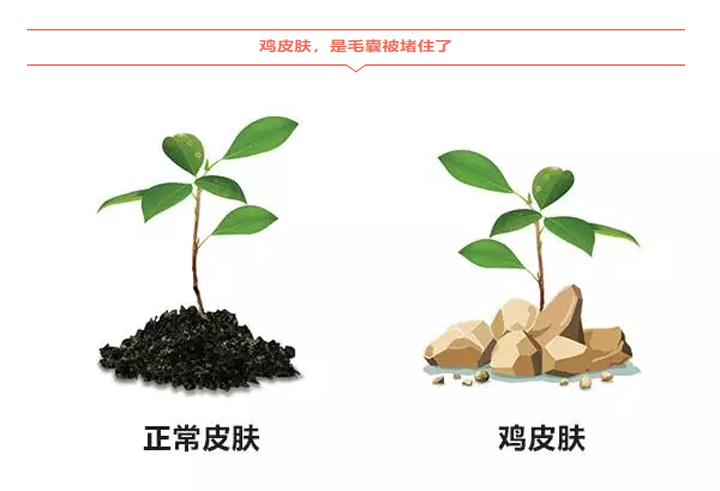 原创鸡皮肤怎么快速消除去鸡皮肤的方法可以从生活中找到