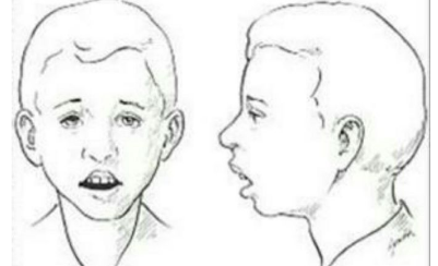 嘴短牙凸,腺样体肥大儿童面容怎么办?