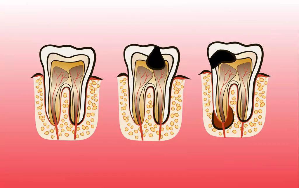 龋洞内的细菌和细菌所产生的毒素,容易渗透到牙髓组织,发生更加剧烈的