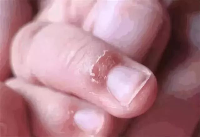 「指甲」儿科医生坦言：孩子是缺锌了，家长上点心吧！孩子5岁还啃指甲