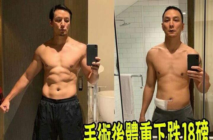 吴彦祖晒盲肠溃烂术后对比照, 自曝暴瘦18磅还差点死掉