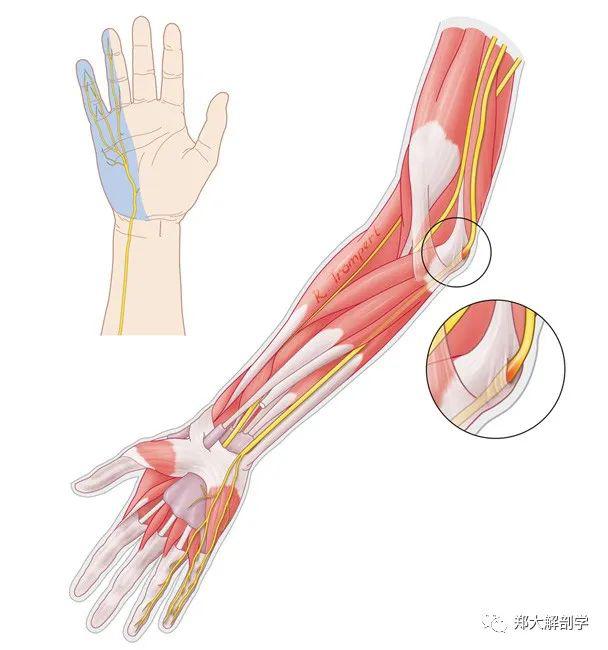 腕部神经卡压腕尺管综合征