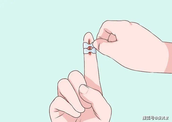其次要促进伤口愈合.