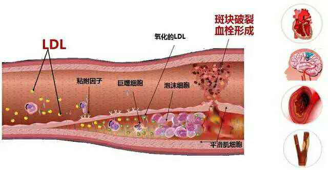 下肢动脉硬化闭塞症:一走就累,下肢动脉可能不好了