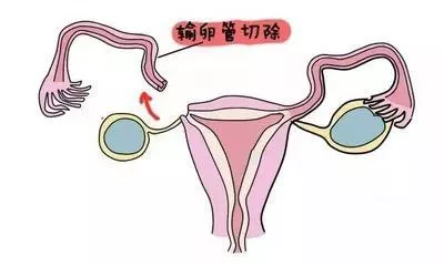 有一部分女性,或许因为宫外孕,或是因为其他原因,切除了一侧输卵管或