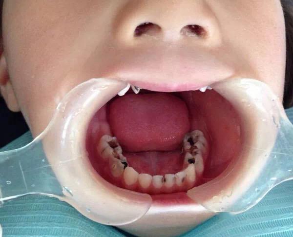 1,第一颗牙齿就要刷 在乳牙萌出前,家长要帮孩子清洁口腔,可以用小块