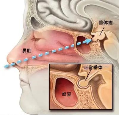 年轻女士提前闭经原因可能是垂体瘤垂体和内分泌密切相关