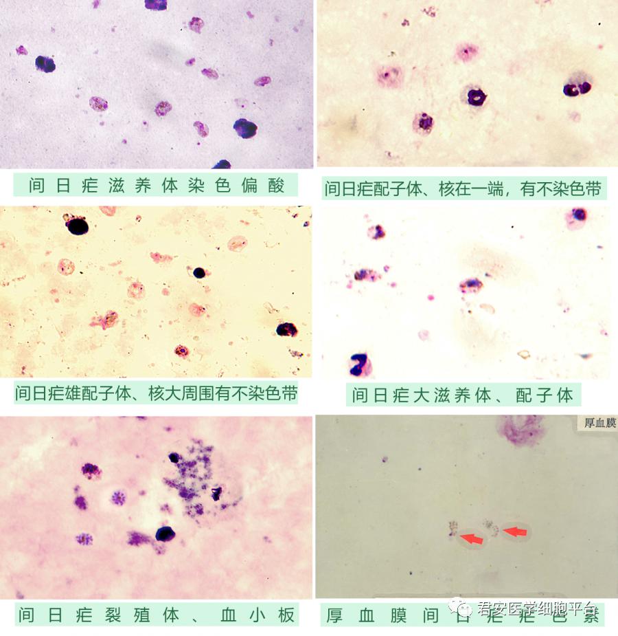 间日疟大滋养体呈阿米巴样运动,胞浆常断裂几块或缩成圆形,核和疟