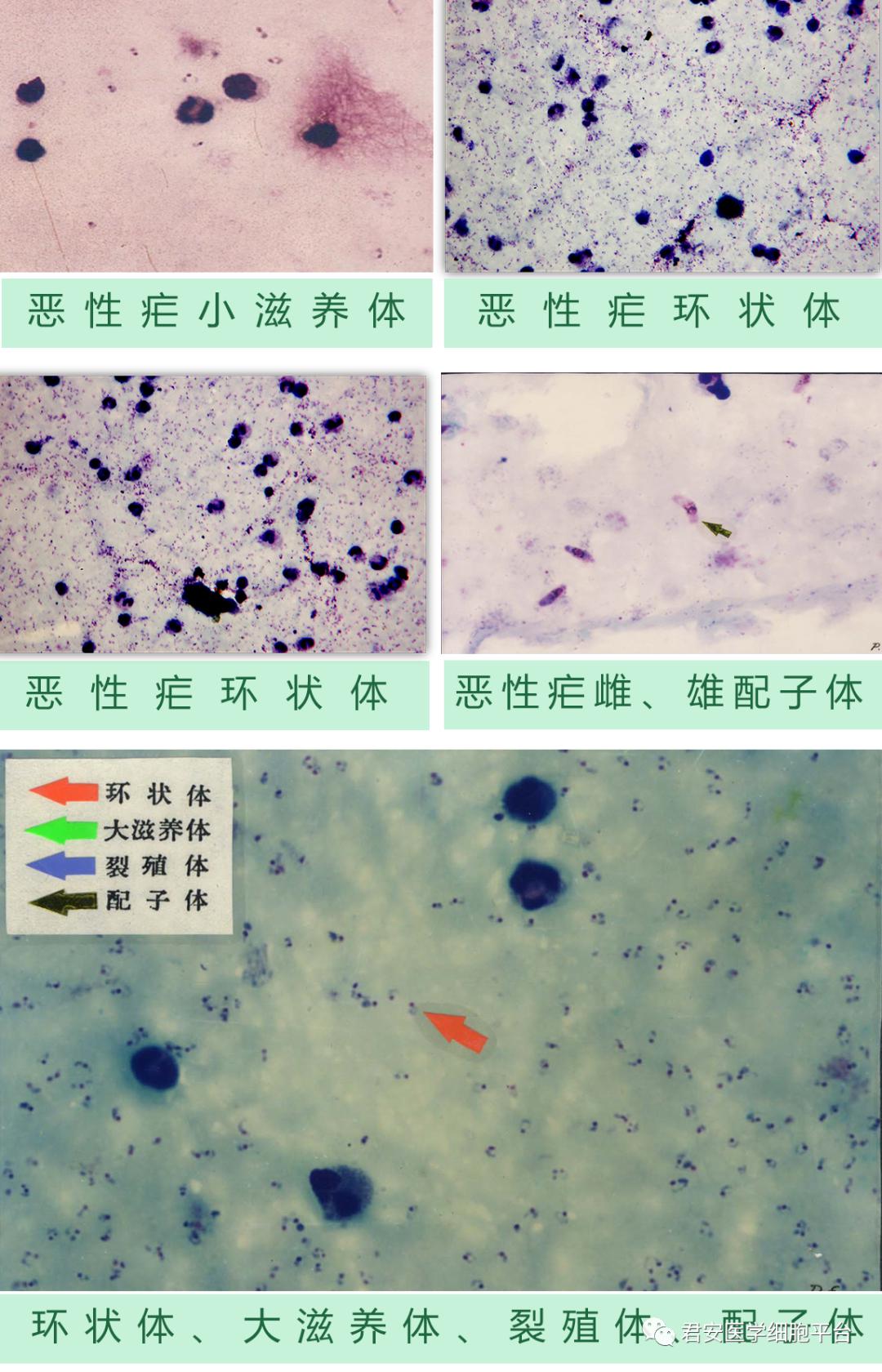 厚血膜间日疟各期形态 厚血膜上可见到的某些杂质 估计疟原虫感染