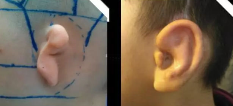 关于耳朵再造手术，再造的耳朵多久才能长好？