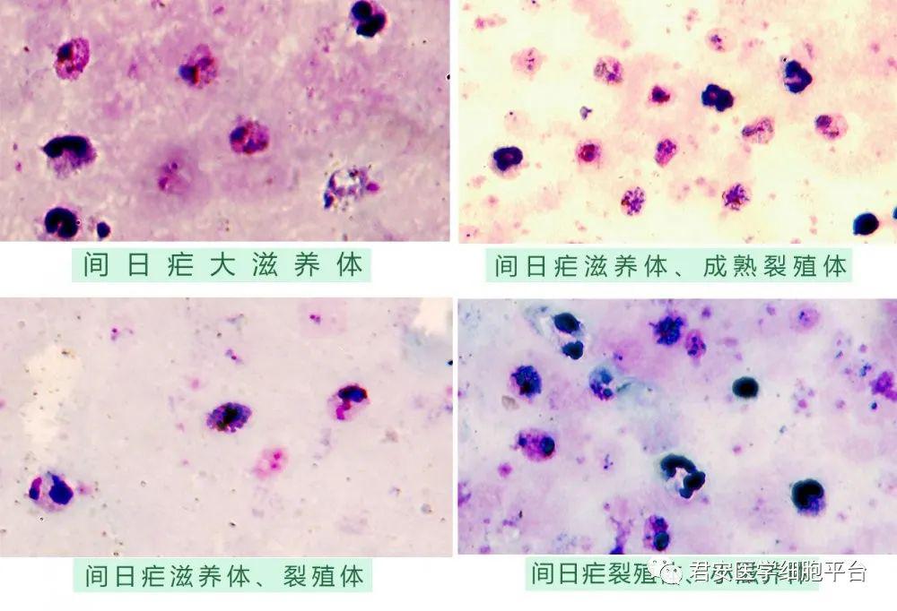 间日疟大滋养体呈阿米巴样运动,胞浆常断裂几块或缩成圆形,核和疟