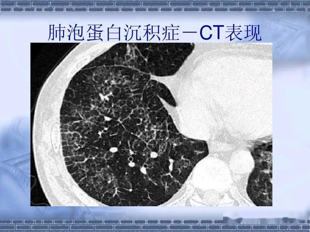 带你认识肺泡蛋白沉积症的影像表现