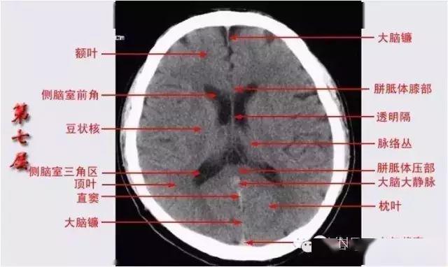 已收藏!颅脑ct解剖口诀 彩色解剖图
