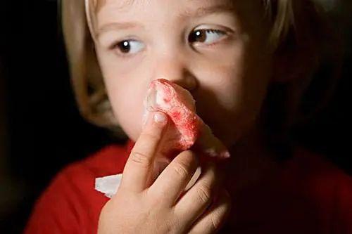 处理：孩子流鼻血如何处理？仰头、塞棉球都是在害宝宝！