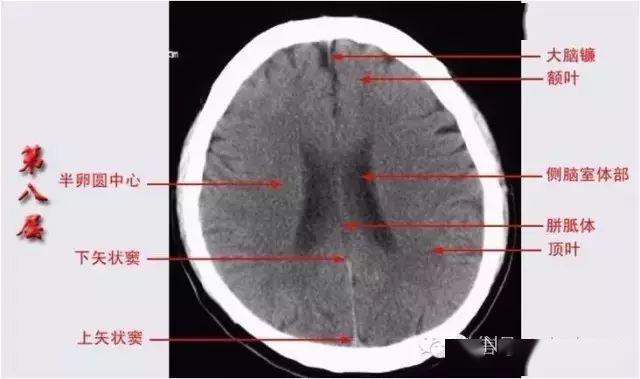 颅脑ct解剖口诀及彩色解剖图