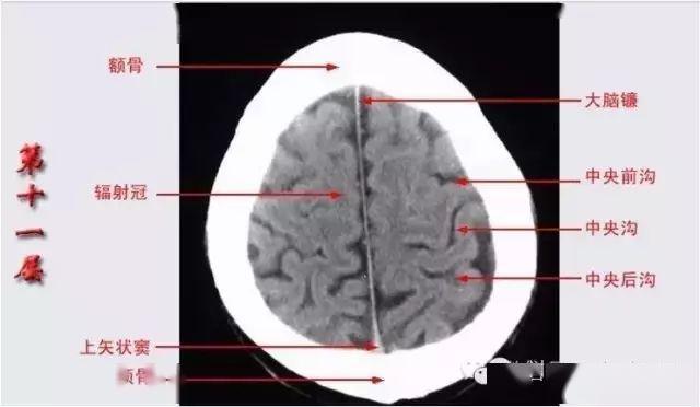 颅脑ct解剖口诀及彩色解剖图
