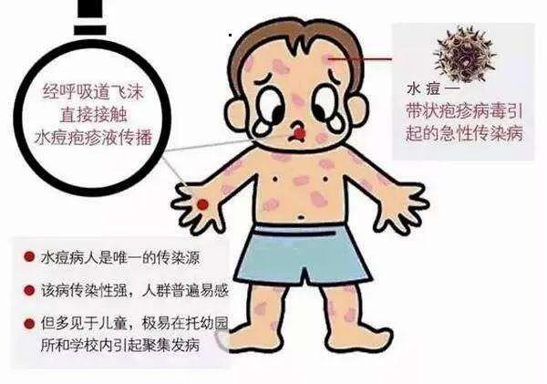 36.流行性腮腺炎