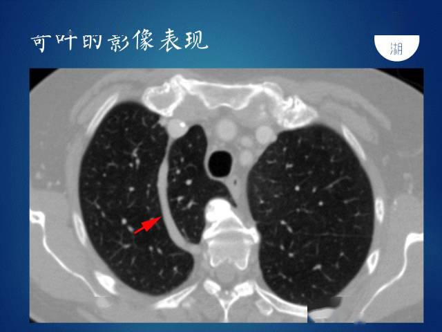 轻松记住:奇静脉,半奇静脉,副半奇静脉,奇裂,奇叶