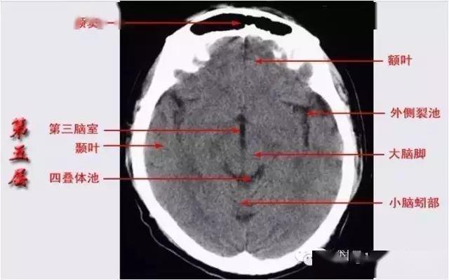 已收藏颅脑ct解剖口诀彩色解剖图