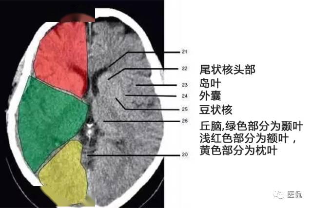 颅脑ct解剖口诀及彩色解剖图