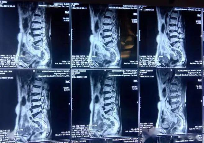 典型病例一个腰痛患者的重生之路