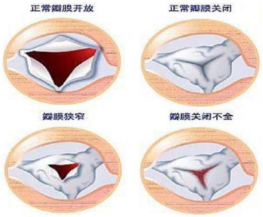 二尖瓣修复还是换掉?如何选择?——河南省人民医院权晓强