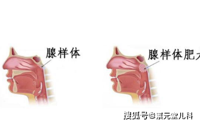 孩子腺样体肥大看过开儿童腺样体肥大治疗方法总结