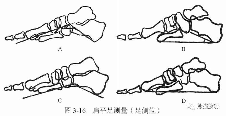 骨关节丨画线及测量