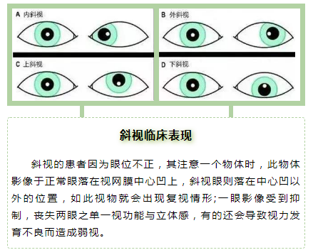 麻痹性斜视则有眼球运动受限,复视,可为先天性,也可因外伤,或全身性