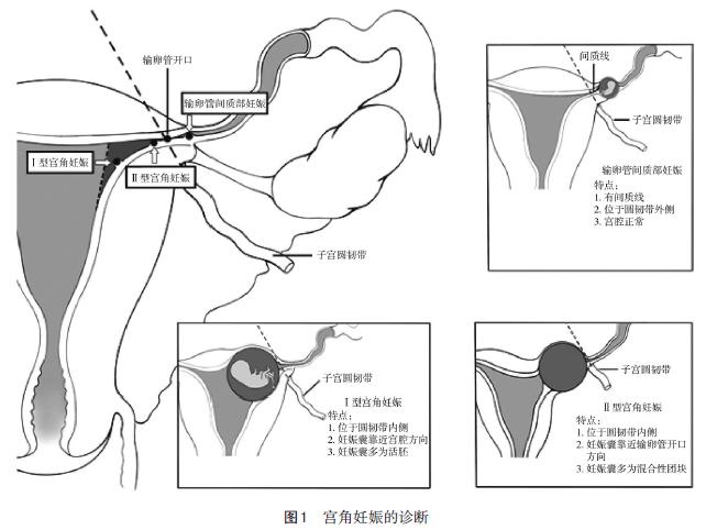 宫角妊娠诊治专家共识