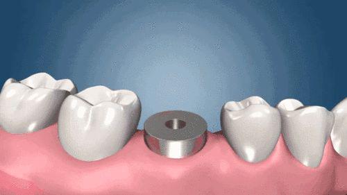 取模型制作上部牙冠 待种植体周围牙龈组织愈合6-8周后, 卸除愈合基台