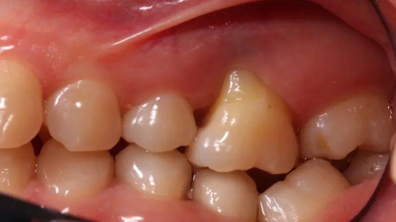 脆弱和过薄的牙槽骨与牙龈,牙齿在牙弓中位置异常