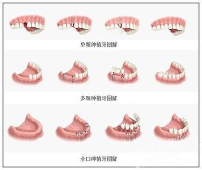 嘉和口腔种植牙案例分享