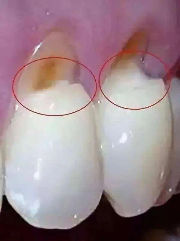 口腔医生的难题:牙龈萎缩怎么办?