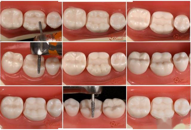 齿美备牙指南一步一步做好嵌体高嵌体牙体预备