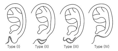 耳垂形状不正常耳垂畸形其实可以进行手术