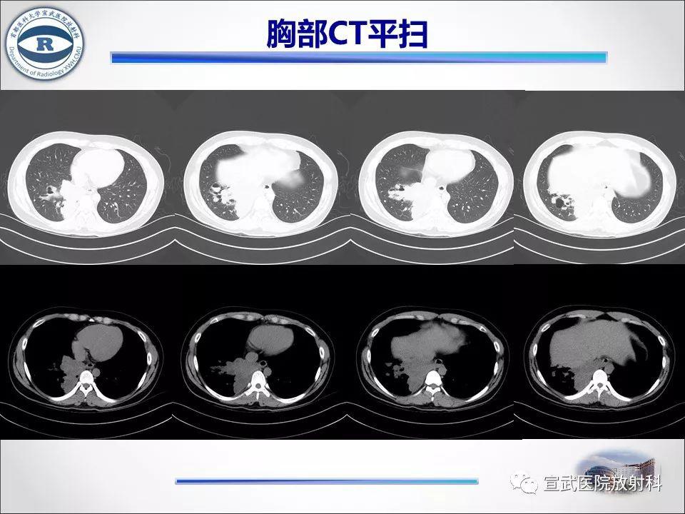 肺隔离症的影像表现