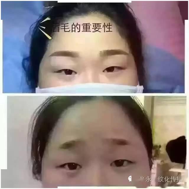 眉毛掉了一块怎么办