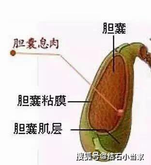 谨防胆囊息肉癌变,胆囊息肉的最佳治疗方式是什么?